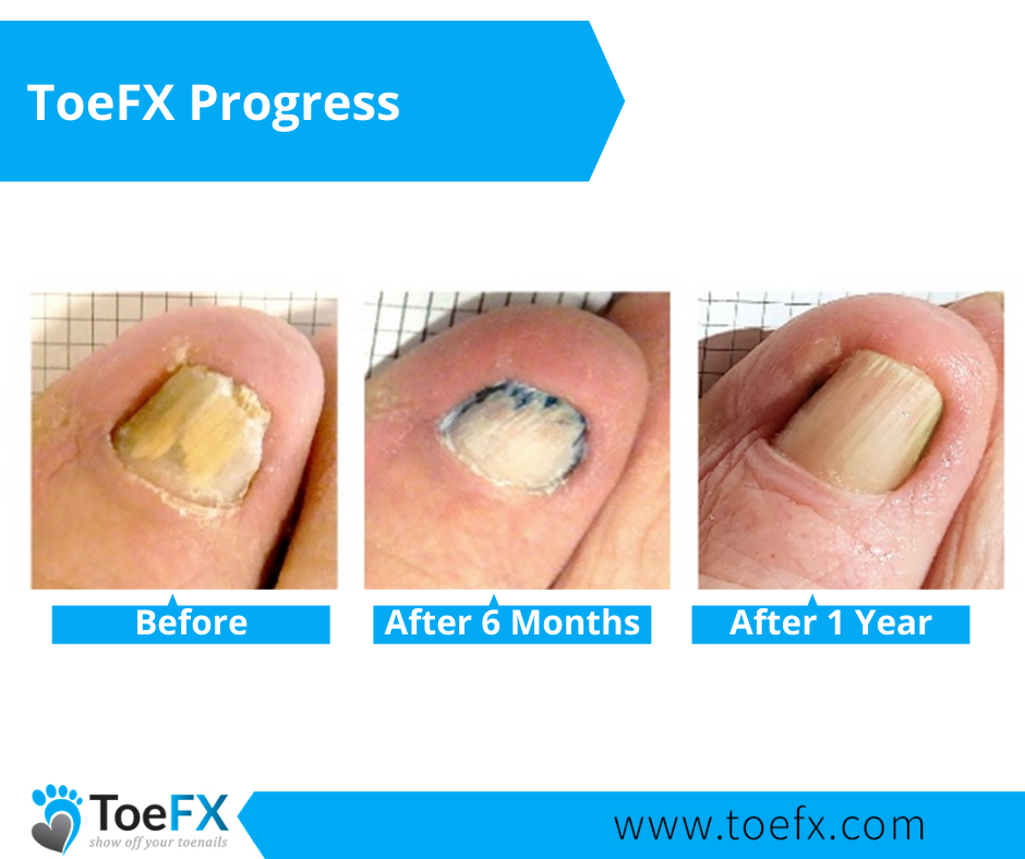 toefx-progress-gallery-1