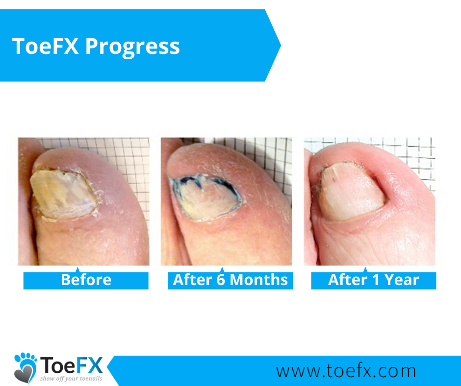 toefx-progress-gallery-2