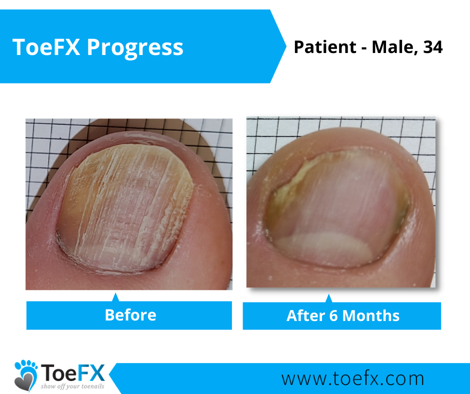 toefx-progress-gallery-4