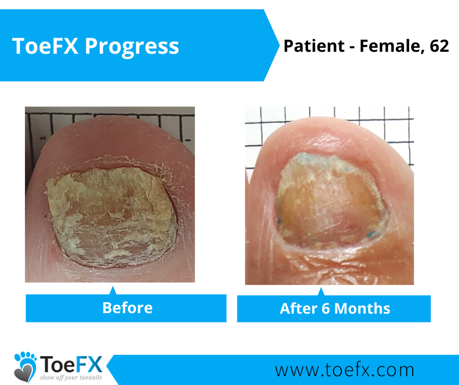 toefx-progress-gallery-5